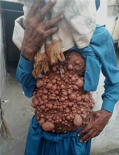 تصاویر مردی که هزاران بیضه روی بدن و صورتش دارد (مرد حبابی) تصاویر مردی که هزاران بیضه روی بدن و صورتش دارد (مرد حبابی)