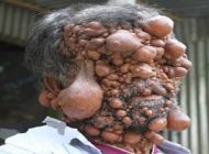 تصاویر مردی که هزاران بیضه روی بدن و صورتش دارد (مرد حبابی)