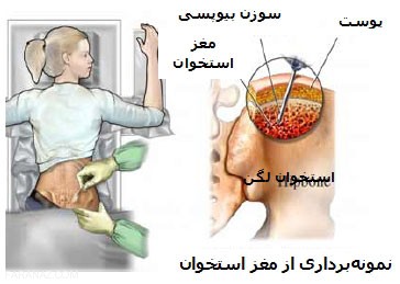 روش های درمانی سرطان استخوان