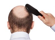 راهکارهای جلوگیری از کچل شدن
