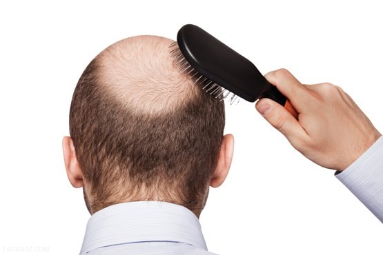 راهکارهای جلوگیری از کچل شدن راهکارهای جلوگیری از کچل شدن
