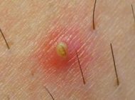موهای زیرپوستی را چگونه از بین ببریم ؟