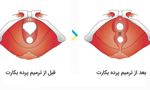 روش های ترمیم پرده بکارت با عمل و بدون عمل + هزینه ترميم بكارت