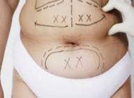 همه چیز درباره عمل جراحی لیپوساکشن Liposuction