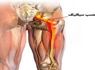 همه چیز درباره بیماری سیاتیک + درمان خانگی درد سیاتیک
