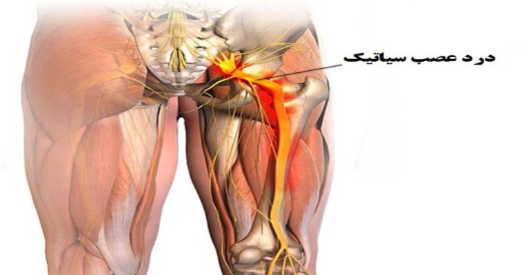 همه چیز درباره بیماری سیاتیک + درمان خانگی درد سیاتیک همه چیز درباره بیماری سیاتیک + درمان خانگی درد سیاتیک