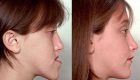 بهترین سن برای جراحی ناهنجاری‌ های فک چه سنی است ؟