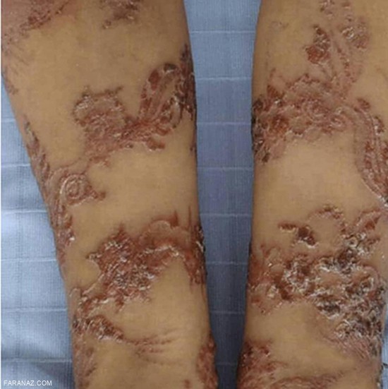 سوختگی کودک 6 ساله بخاطر تتو با حنا + عکس