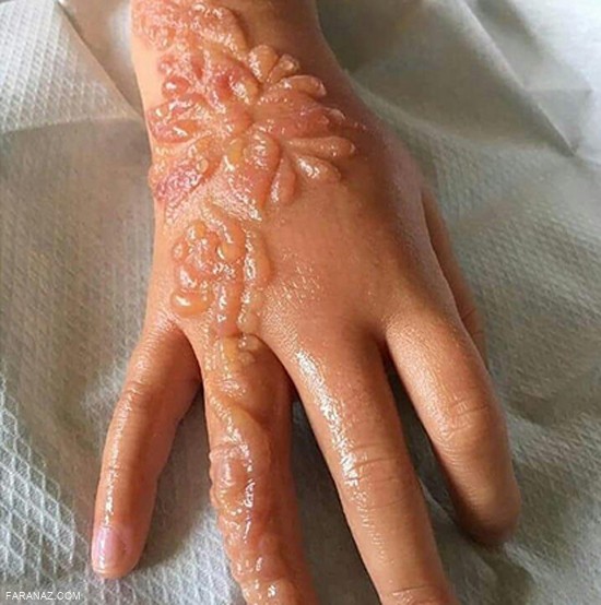 سوختگی کودک 6 ساله بخاطر تتو با حنا + عکس سوختگی کودک 6 ساله بخاطر تتو با حنا + عکس