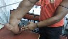 مرد عجیب الخلقه که دستی شبیه پای فیل دارد + عکس