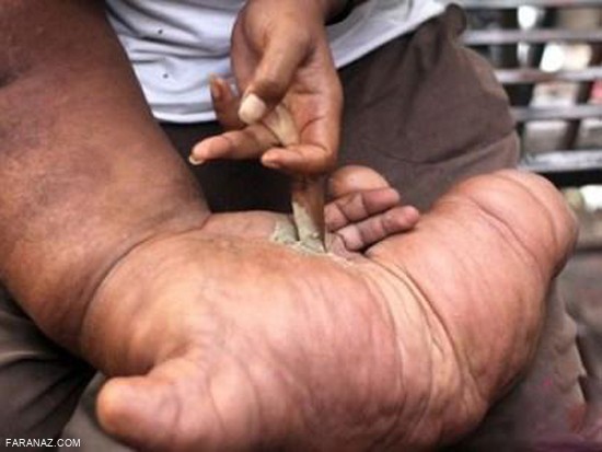 مرد عجیب الخلقه که دستی شبیه پای فیل دارد + عکس