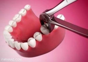 مناسب ترین زمان برای کشیدن دندان عقل چه زمانی است؟