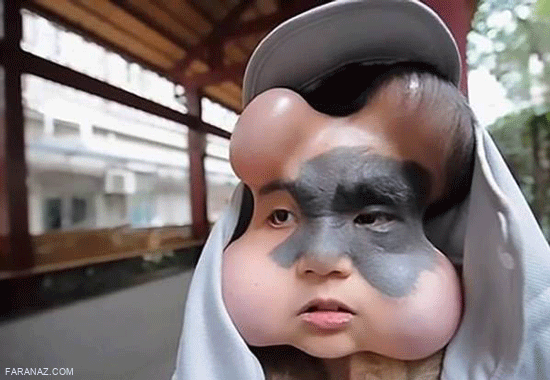 فاجعه ی دردناک بخاطر یک خال مادرزادی