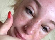 روغن برنزه کننده و بلایی که بر سر پوست می آورد + عکس