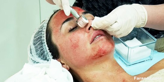 همه چیز درباره میکرونیدلینگ پوست + فواید و مضرات