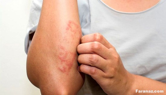 گال یا گال گرفتن چیست؟ آیا میدانید اصطلاح (طرف گال گرفته) یعنی چی؟ گال یا گال گرفتن چیست؟ آیا میدانید اصطلاح (طرف گال گرفته) یعنی چی؟
