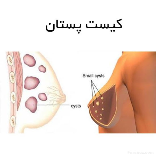 دلایل بروز کیست سینه و تفاوت آن با تومور سینه