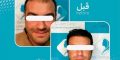 لیست 10 تا از بهترین شامو ها بعد از کاشت مو