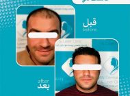 لیست 10 تا از بهترین شامو ها بعد از کاشت مو