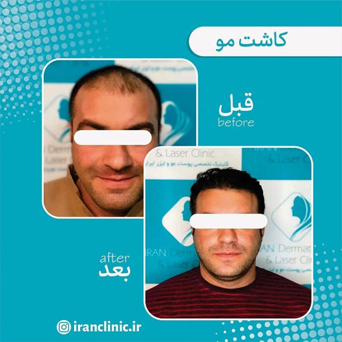 لیست 10 تا از بهترین شامو ها بعد از کاشت مو لیست 10 تا از بهترین شامو ها بعد از کاشت مو