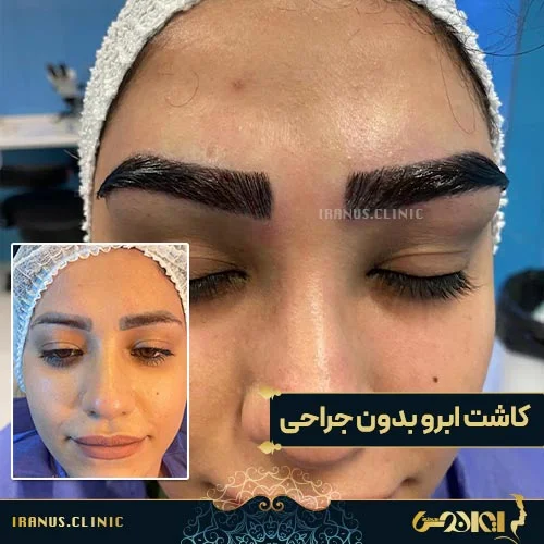 نحوه شستشوی ابروهای کاشته شده به چه صورت است ؟