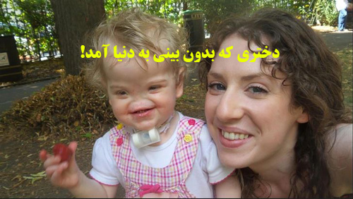 دختری که بدون بینی بدنیا آمد و همه را شیفته خود کرد + عکس