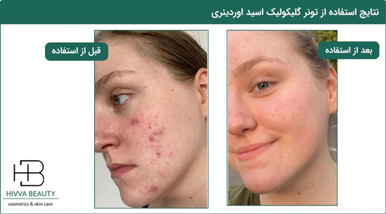 اوردینری را در روتنی پوستی خود حتما جای دهید