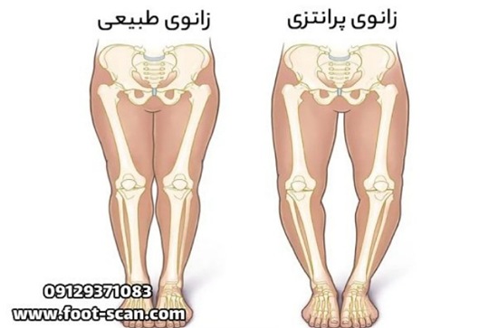 تشخیص زانوی پرانتزی و ضربدری در کودکان
